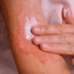 Crema psoriazis