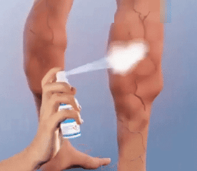 Spray vene varicoase