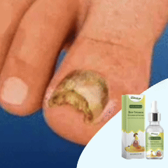 Ser unghii incarnate